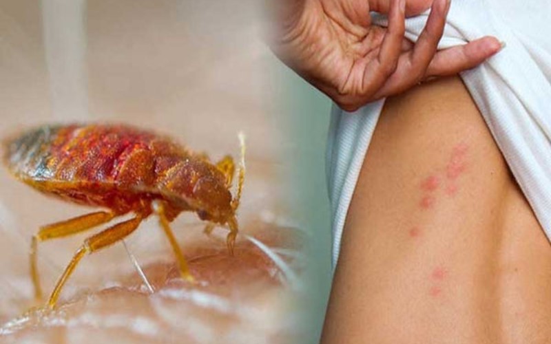 Rệp giường – thủ phạm gây ngứa nghiêm trọng